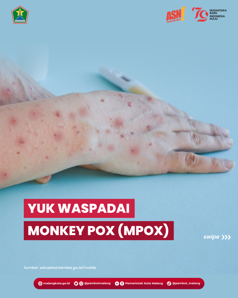 WASPADAI MONKEY POX (MPOX)